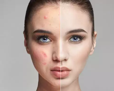 Sfaturi pentru pielea cu imperfecțiuni
